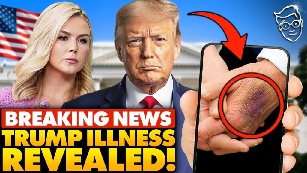 White House Makes SHOCK Announcement on Trump’s Health After ‘Bruising’ Photos Go VIRAL: “Doctors..